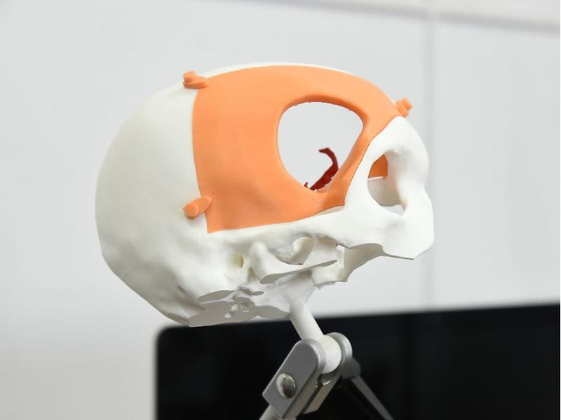 Muestra de la impresión 3D para una craneoplastía, creada en el Neurolab 3D.